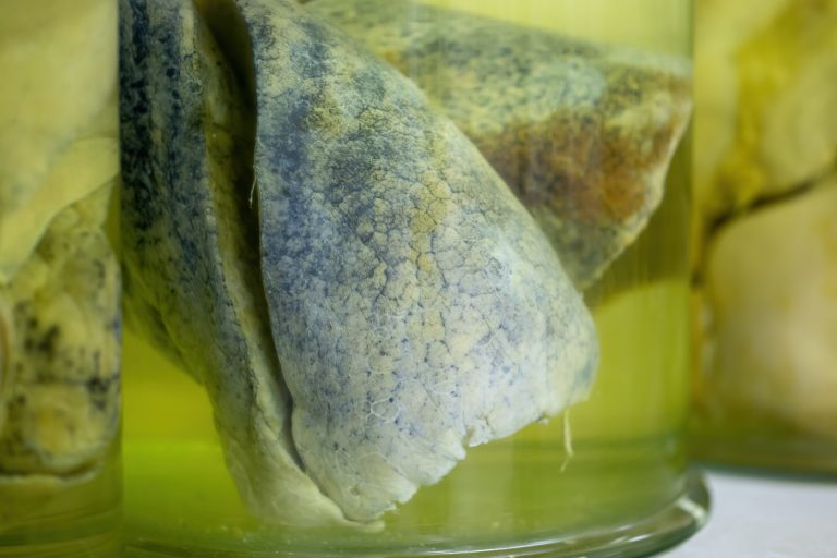 Lungs with cancerous changes floating inside jar with formaldehyde in morgue